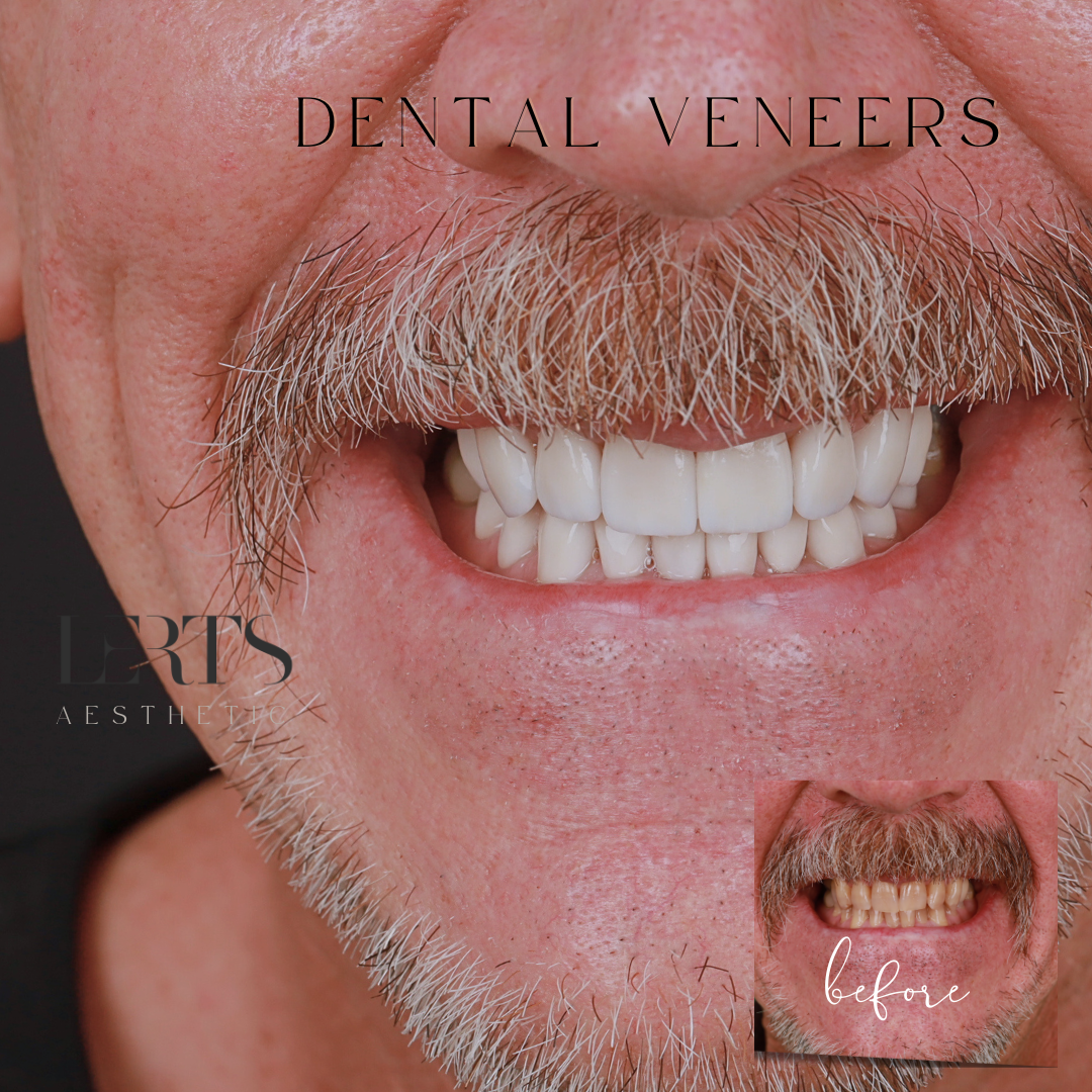 Implant and Veneers Combination