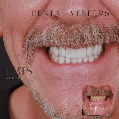 Smiling man's mouth with bright white dental veneers; before and after showing stained teeth.