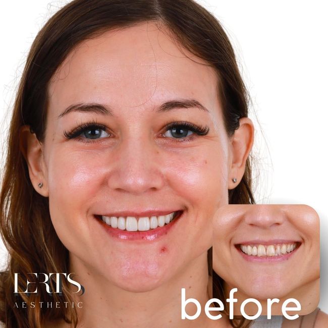 Woman smiling, showing before/after teeth whitening; inset shows original smile with slight discoloration.