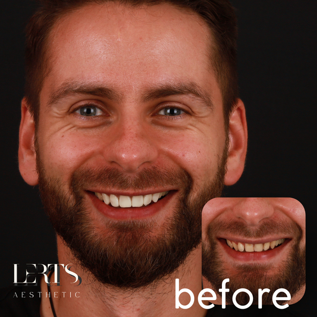 Man with new smile; "before" inset showing teeth. Dark background. He's smiling with teeth visible.