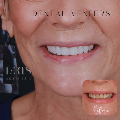 Woman's smile with dental veneers. Before/after comparison shows whiter teeth. Text overlay: "Dental Veneers".
