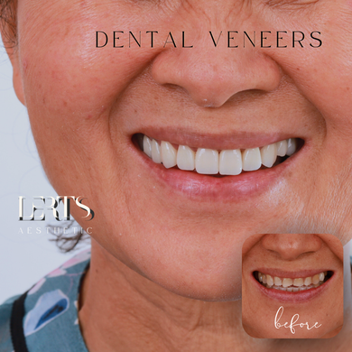 Woman's smile with dental veneers; bright white teeth compared to before photo of stained teeth.