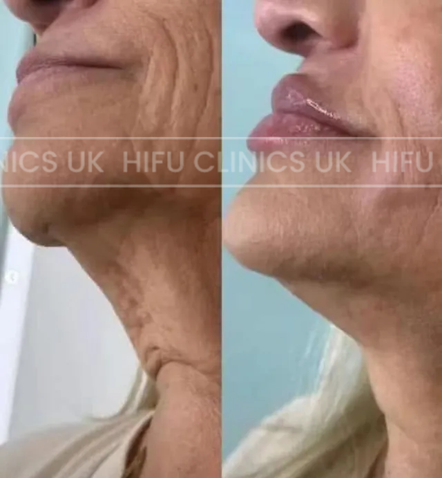 A before and after photo of a woman 's face. HiFu Clinics UK