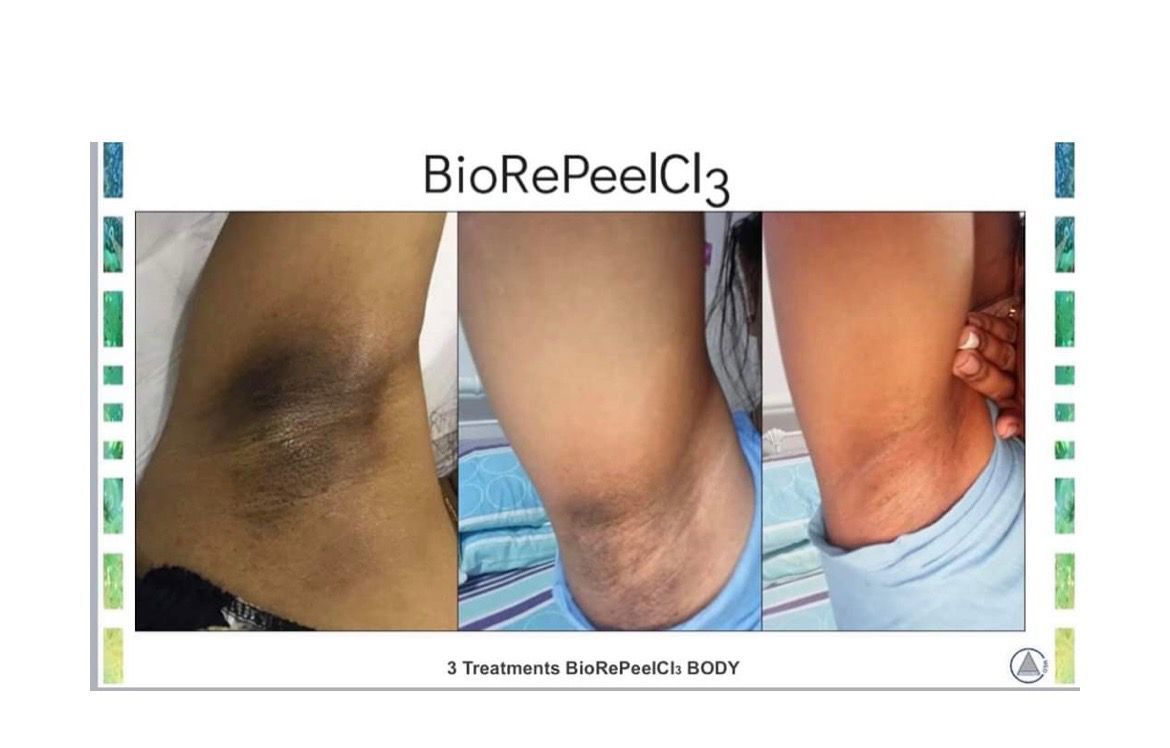 Three pictures of a person 's armpits with the words biorepeelcl3 on the bottom