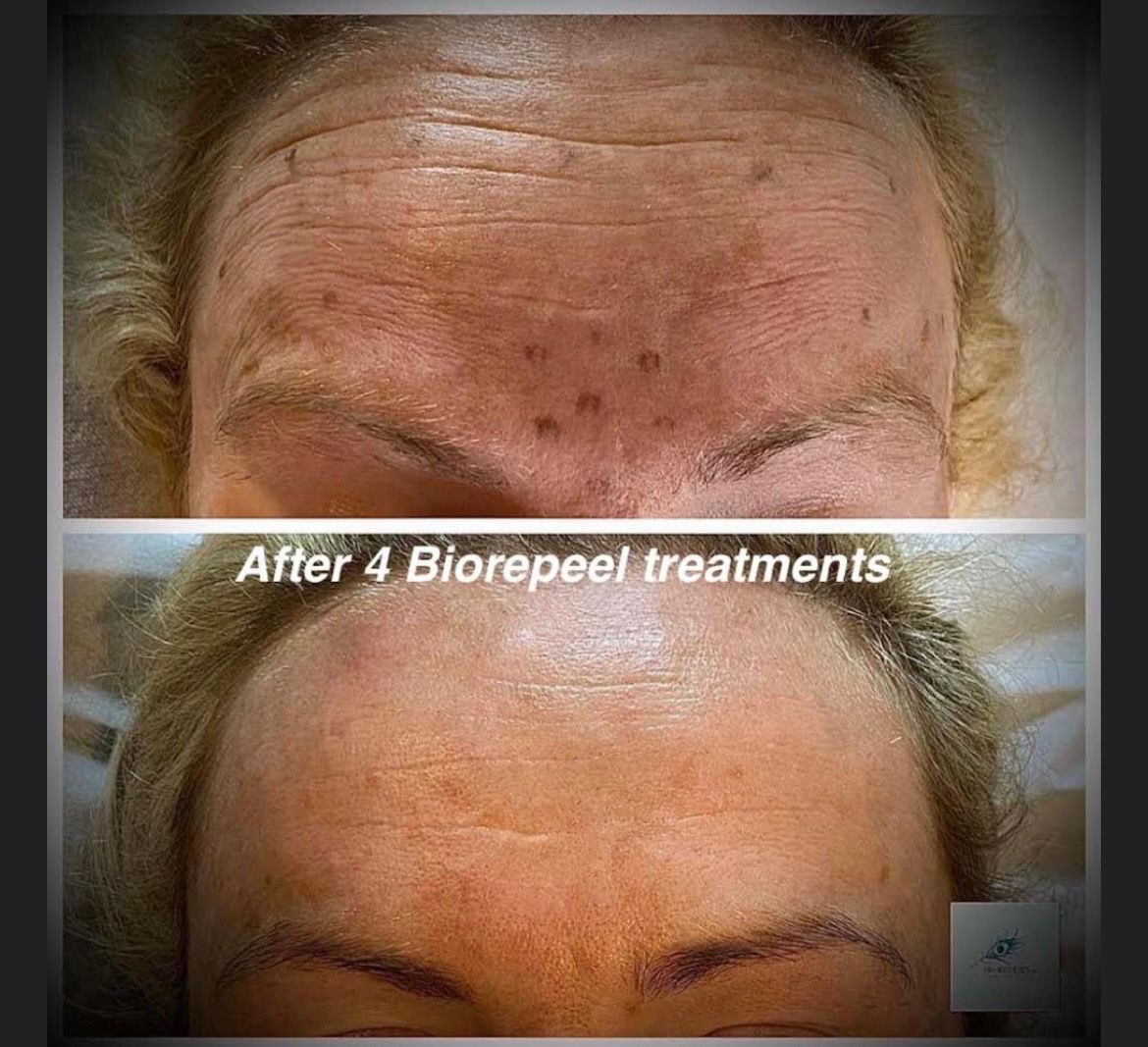 A before and after photo of a woman 's forehead.
