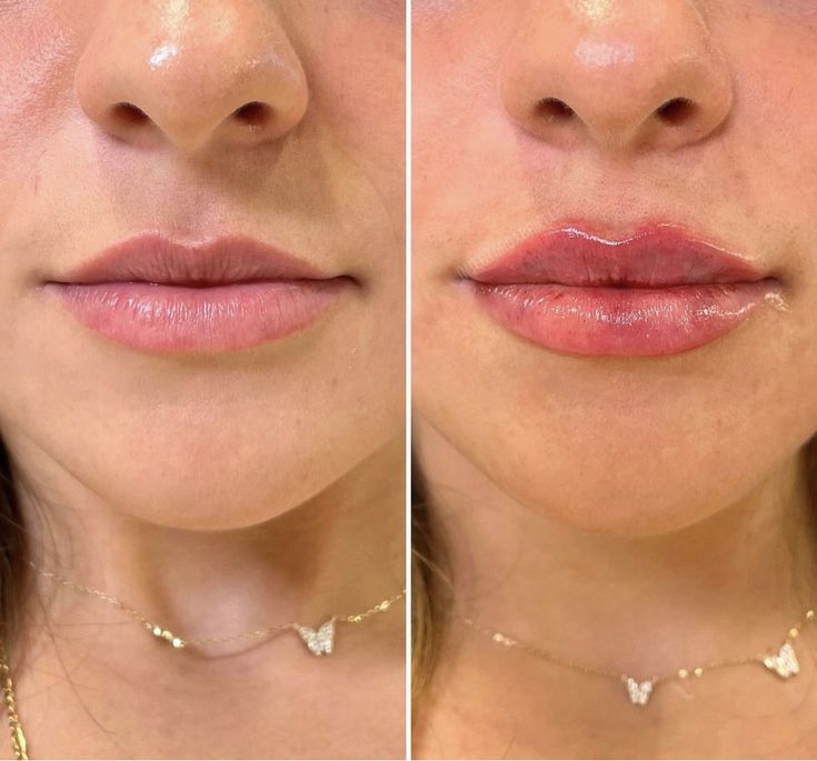 A before and after picture of a woman 's lips.