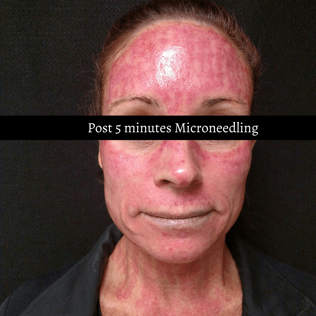 A woman 's face with red spots and the words post 5 minutes microneedling