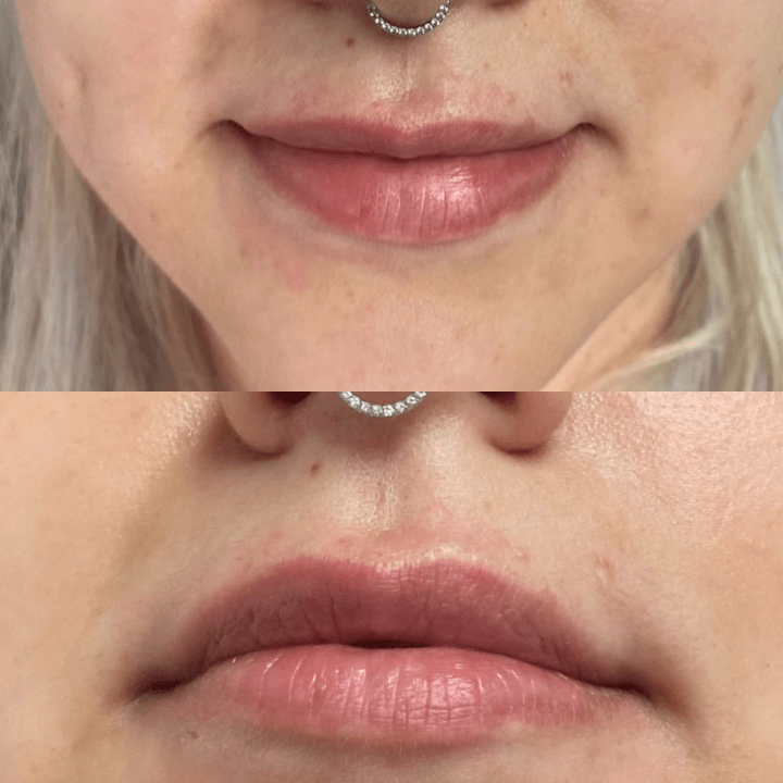 A before and after photo of a woman 's lips with a nose ring.