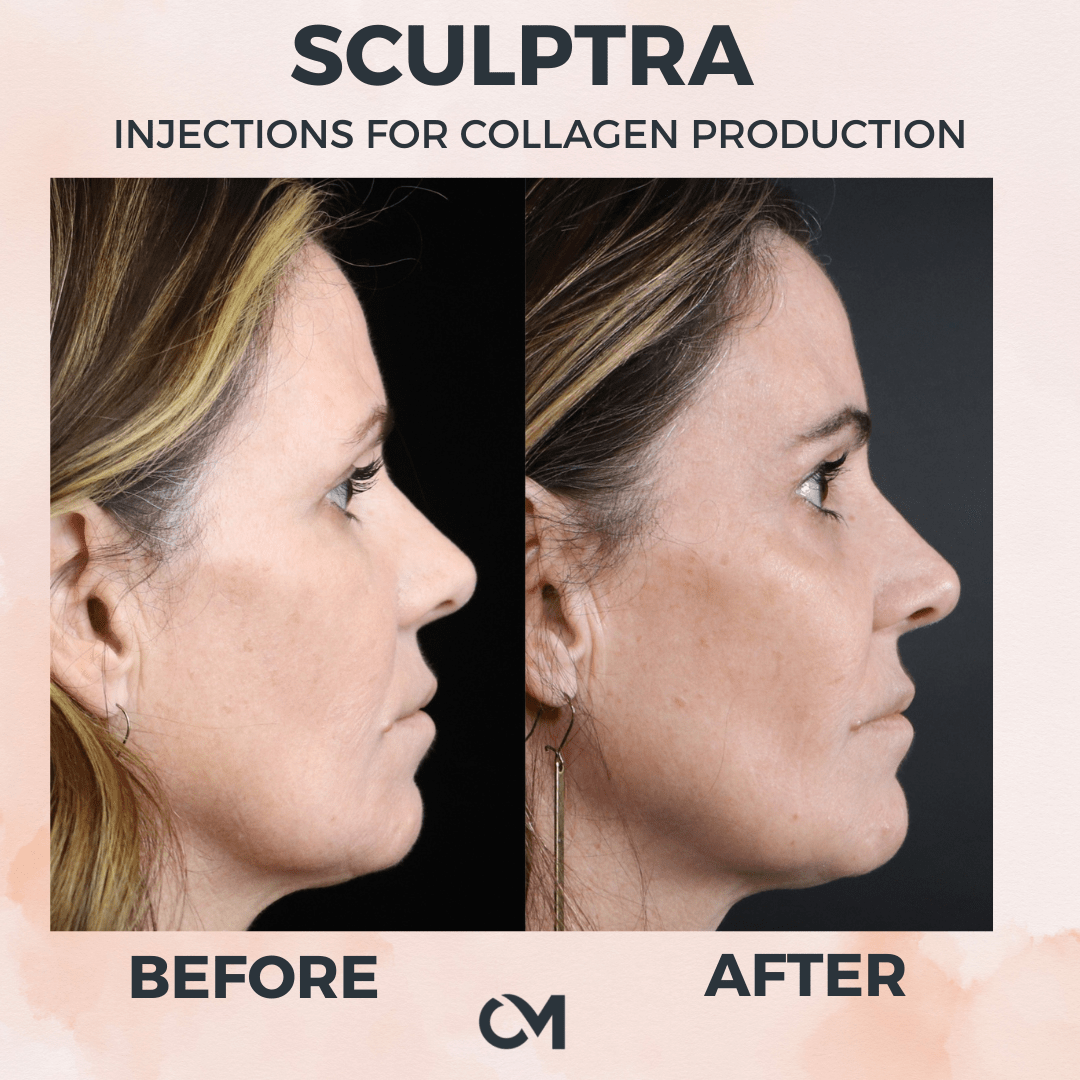 A before and after photo of a woman 's face with sculptra injections for collagen production.