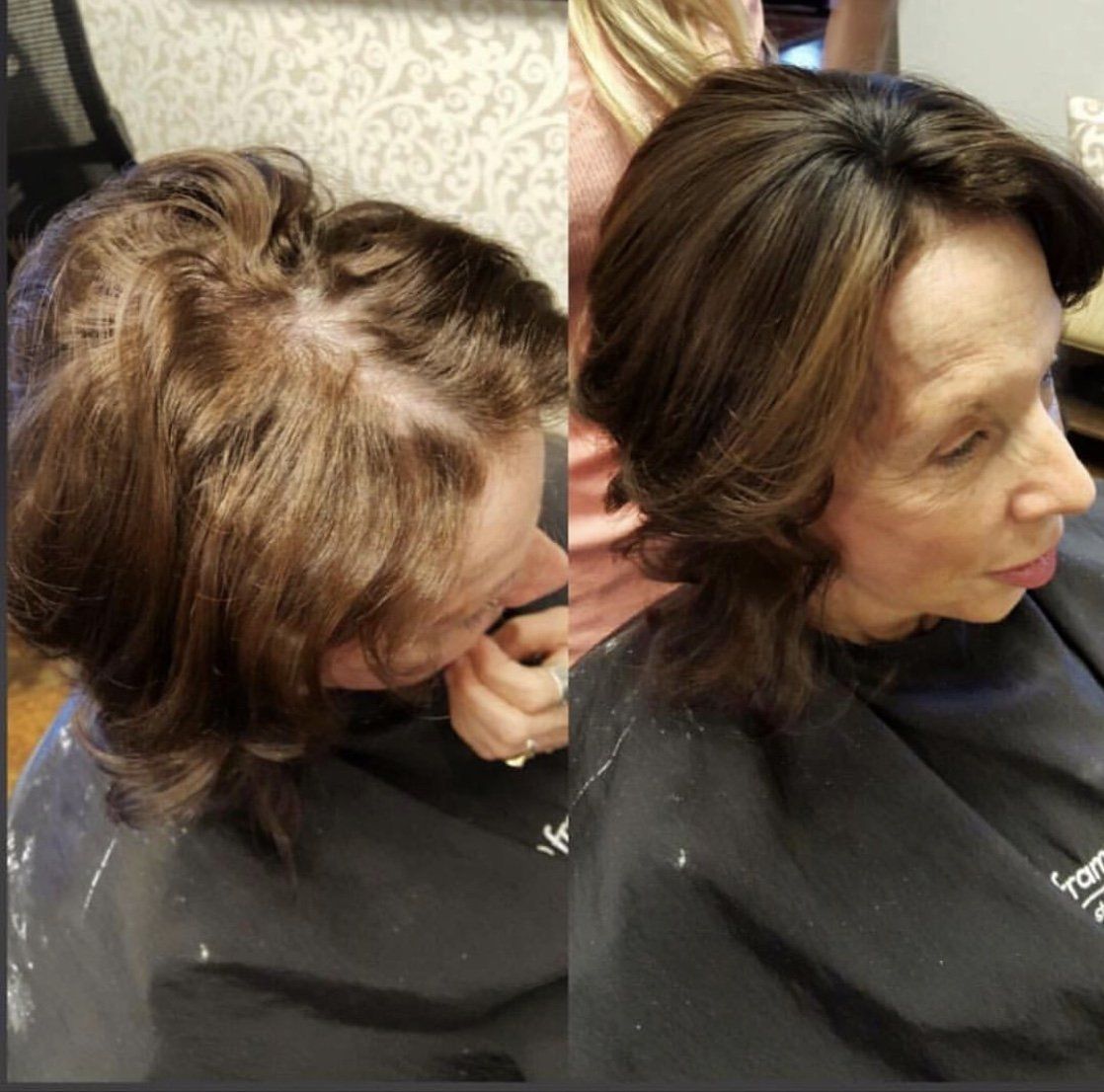 Woman with Hair Lost and Treatment — Greenville, SC — Artistic Cutters Salon & Day Spa