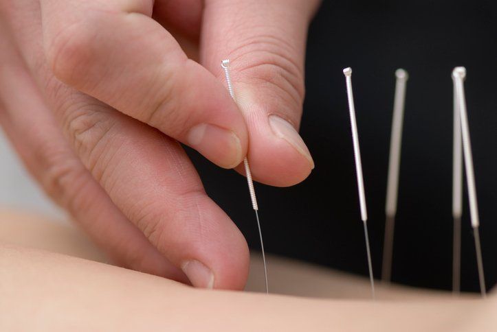 Using Acupuncture Needles — Lake City, FL — Michael C. Schwartz Acupuncture Physician