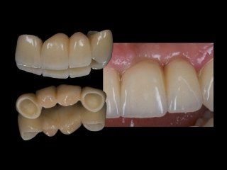 Realizzazione di protesi dentarie su misura