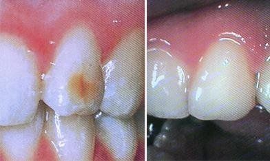 Denti prima e dopo rivitalizzazione