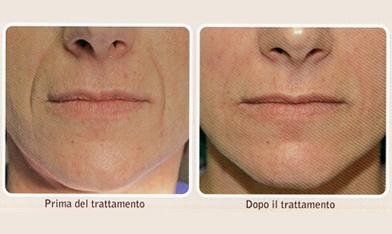 Bocca prima e dopo trattamento di estetica dentale