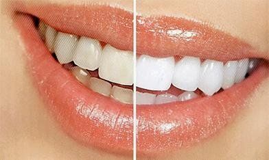 Denti prima e dopo lo sbiancamento dentale