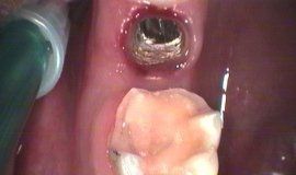 Innesto di impianto dentale