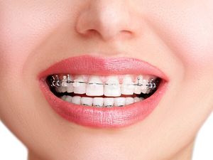 Applicazione di apparecchi ortodontici