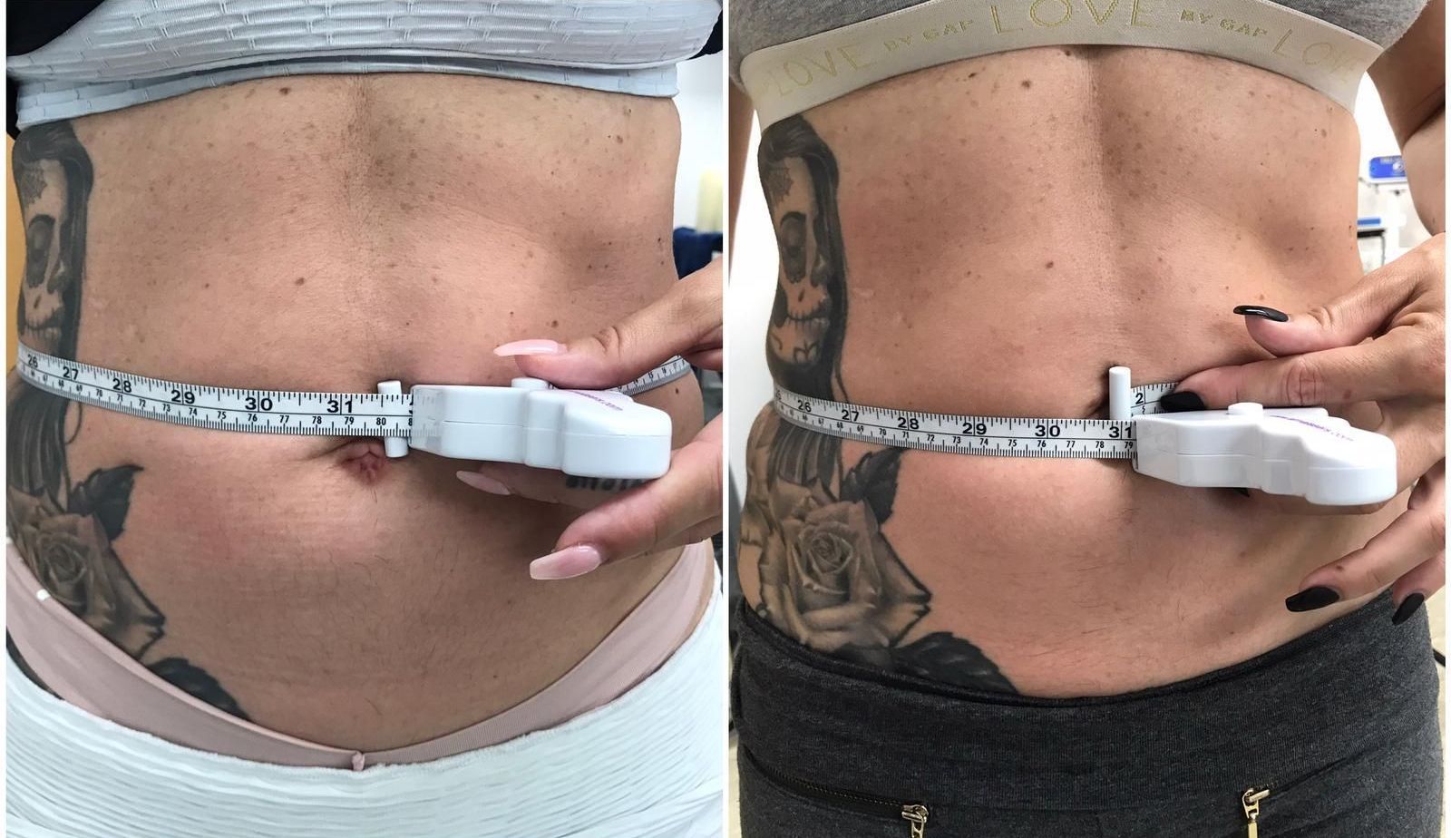 Two side-by-side abdominal views. A person measures their waist with a tape measure, showing a before and after comparison.