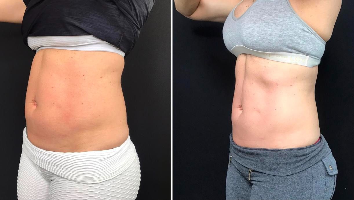 Before and after abdomen showing reduced fat. Left side: torso with excess fat. Right side: toned torso.
