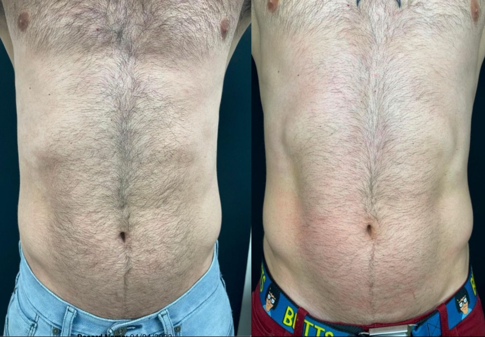 Side-by-side comparison of a torso before and after body contouring, showing reduced fat and defined abs.