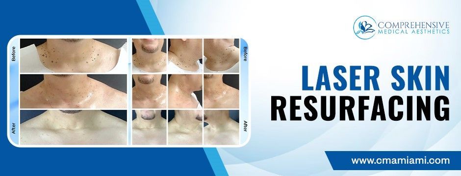 Laser Skin Resurfacing