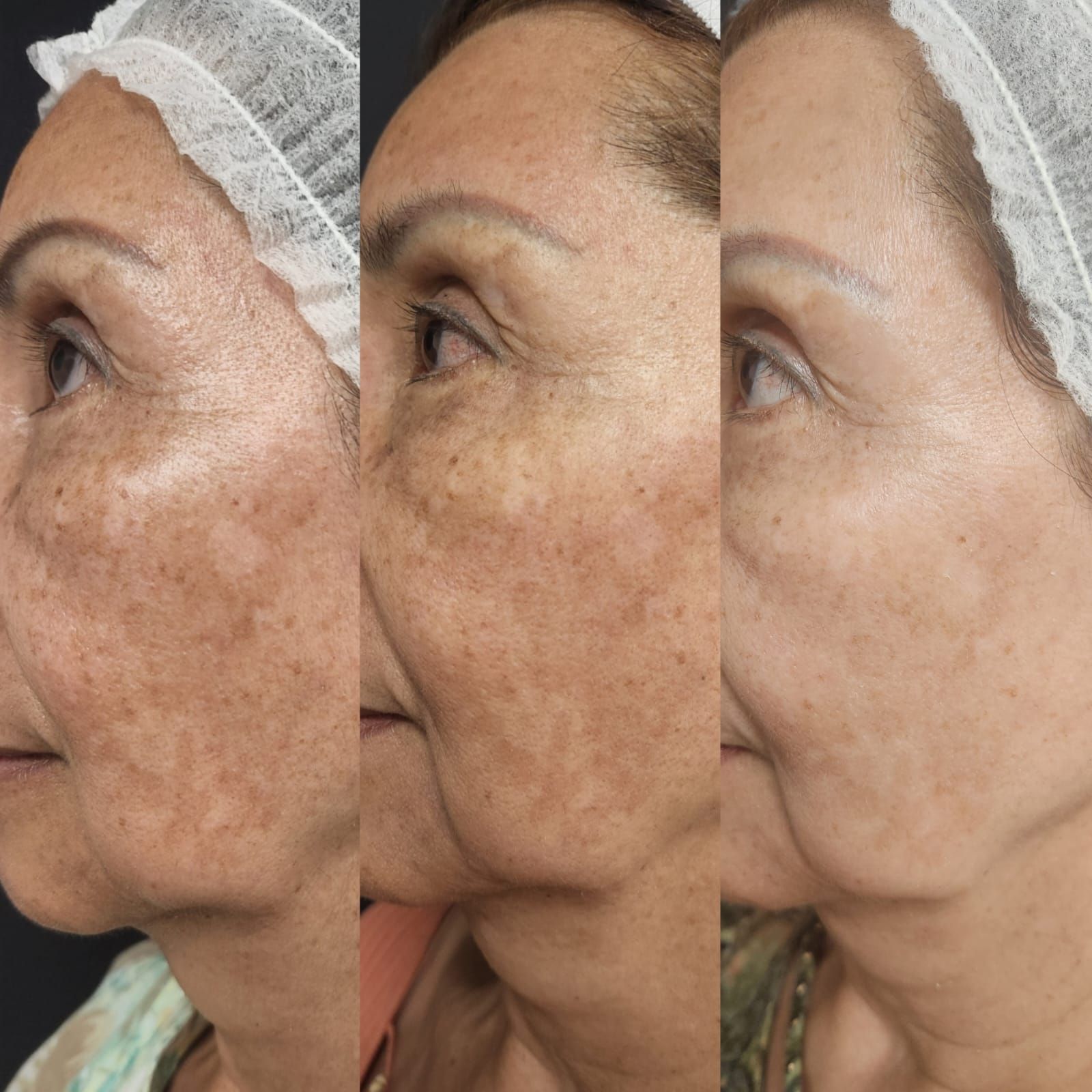 Three side-profile facial images showing a decrease in skin discoloration over time.