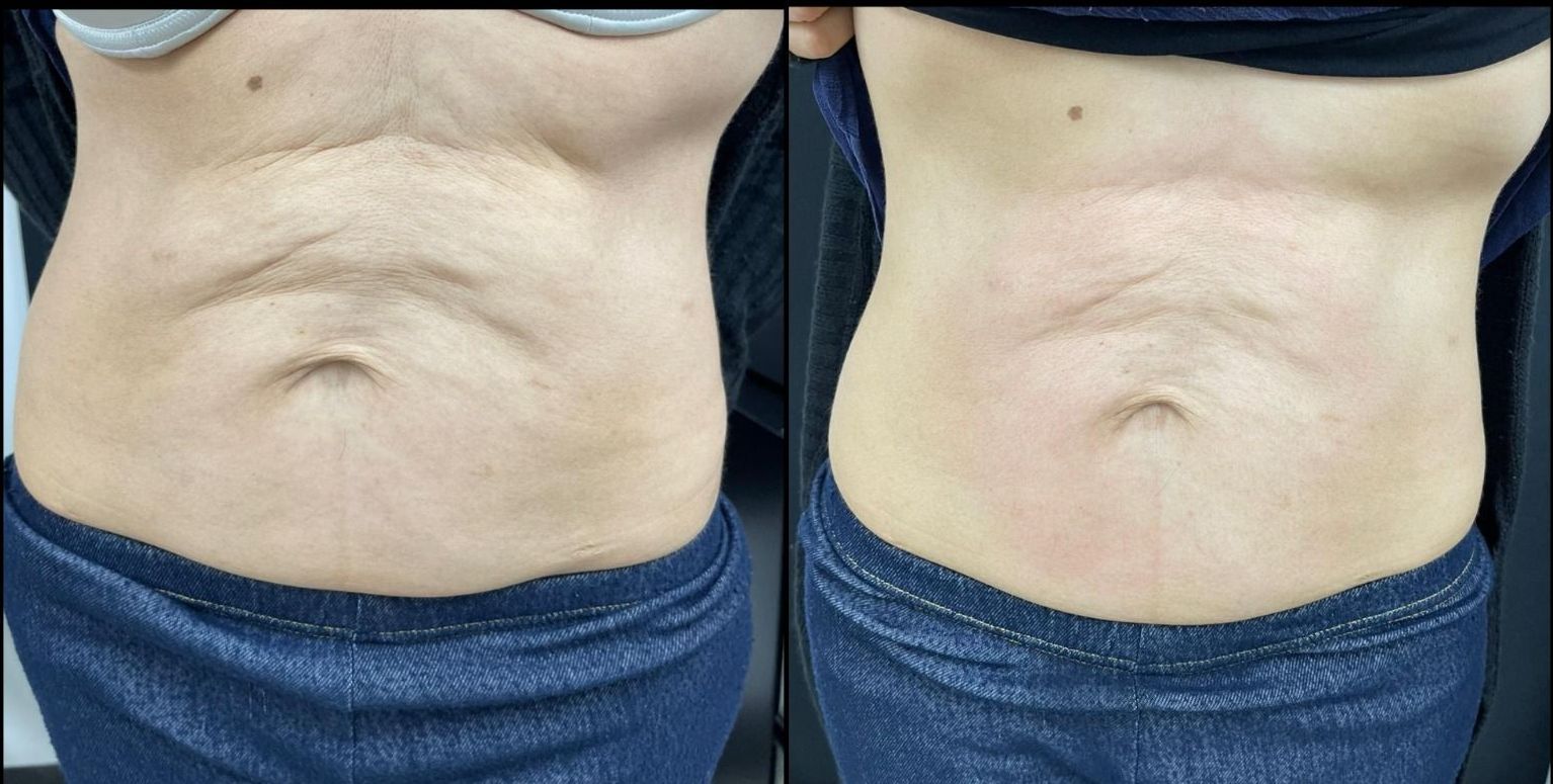 Before and after images of a person's abdomen, showing a reduction in wrinkles and improved skin appearance.