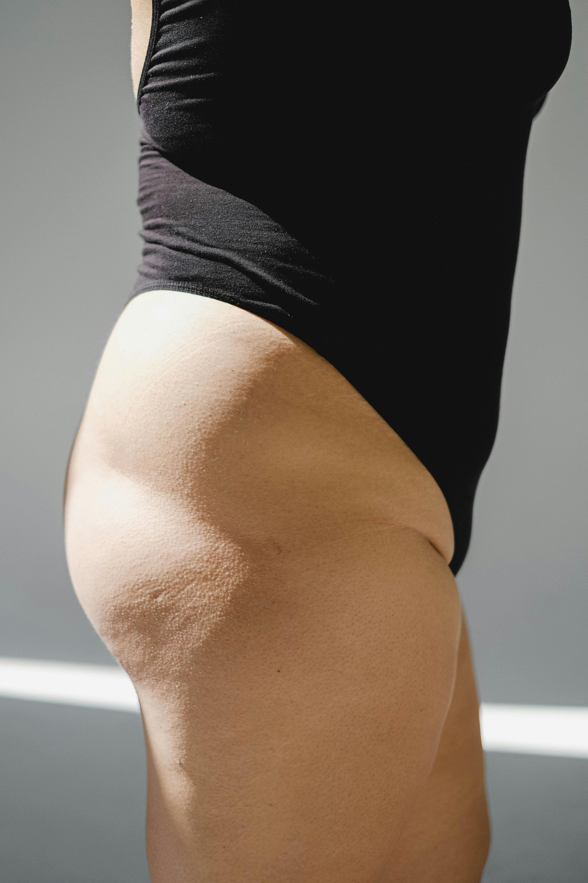 Side view of a person in a black leotard, showing the hip and thigh, with textured skin.
