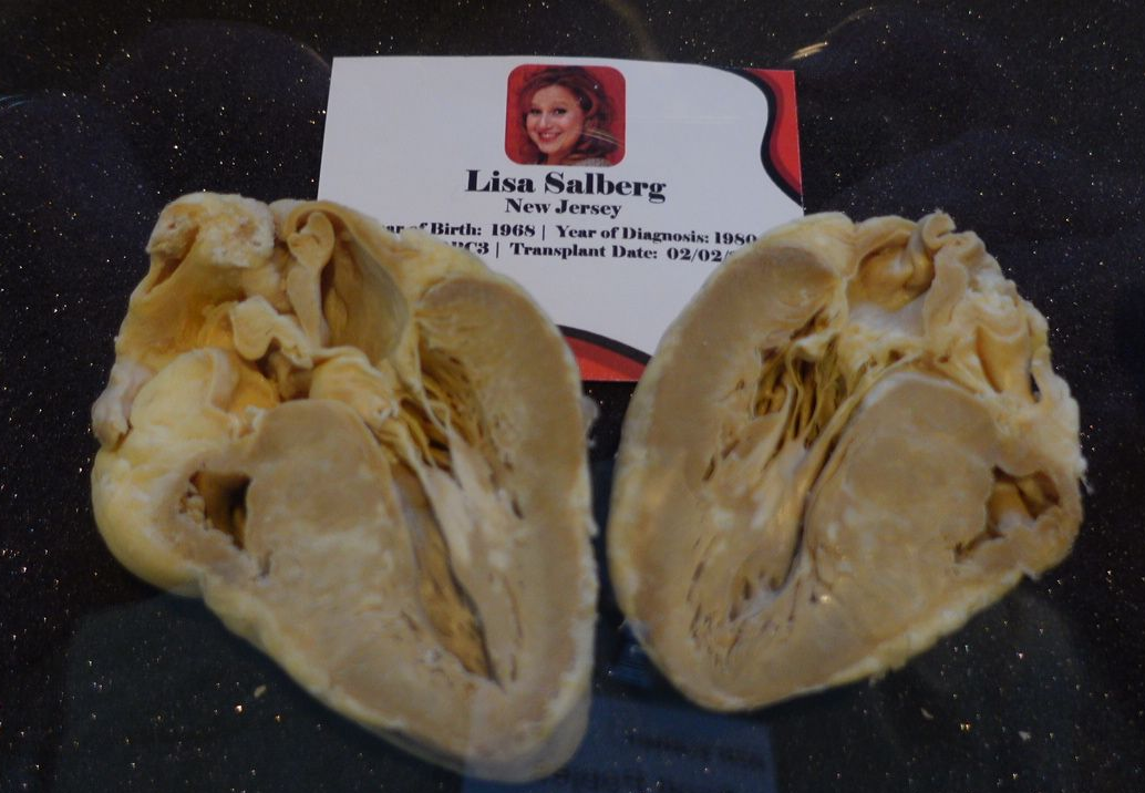 Lisa's Original HCM heart