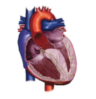 Diagram of HCM heart with 
obstruction