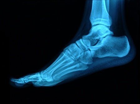 An x-ray will determine whether or not you have a stress fracture