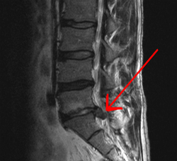 MRI showing a hernia (bulging disk) in the spine.