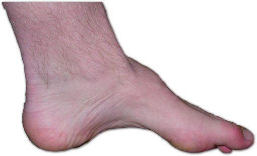 Cavovarus Feet