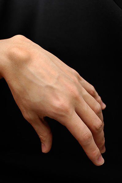 A picture of a ganglion cyst on the hand.