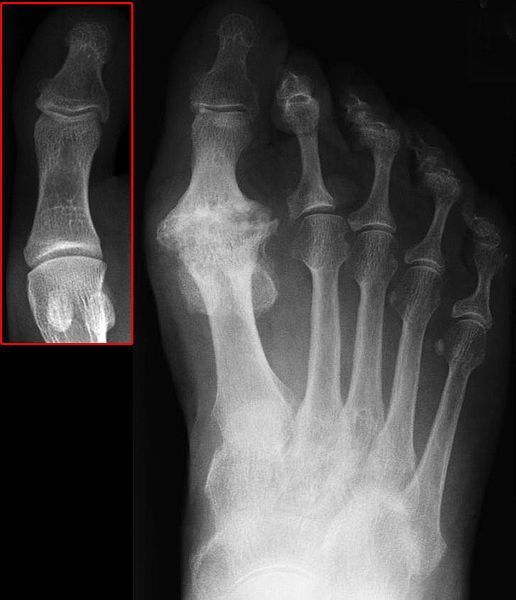 Radiological image showing a case of hallux rigidus.