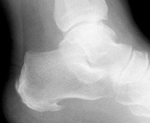 An x-ray showing a heel spur