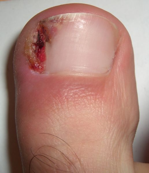 Picture of an ingrown toenail.