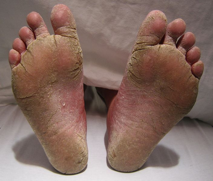 A severe case of Athlete’s foot.