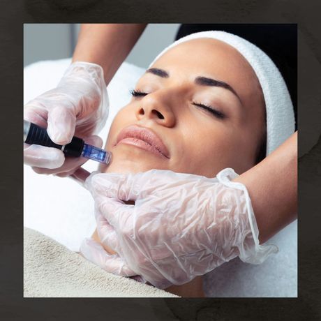 microneedling