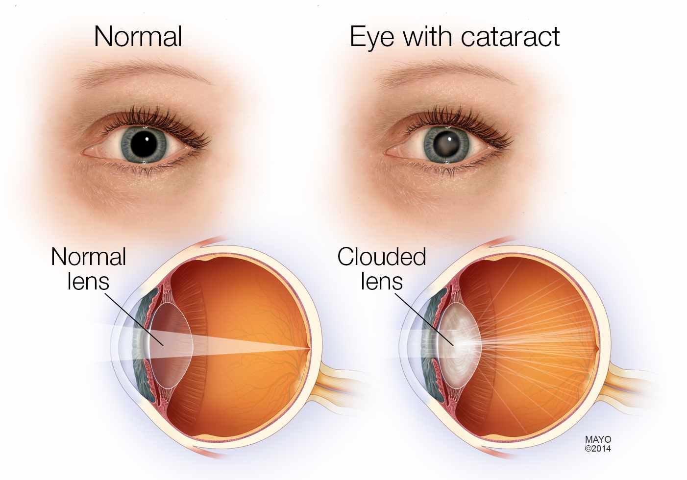 Что нельзя после операции катаракты глаза. Хрусталик глаза. Помутнение хрусталика глаза.