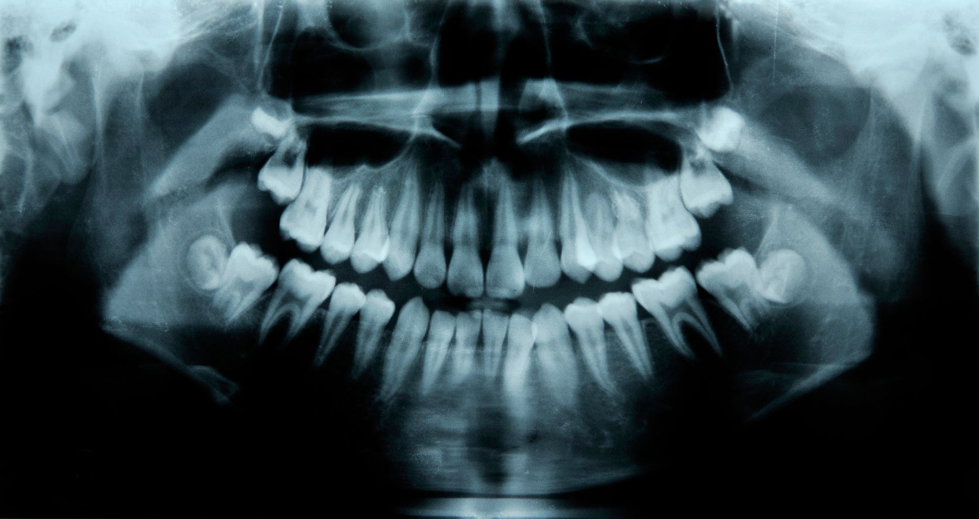 radiografia denti