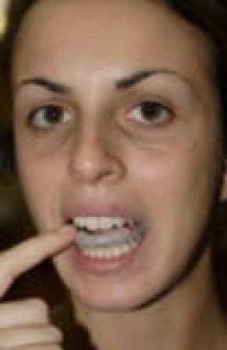 Apparecchio bite invisibile