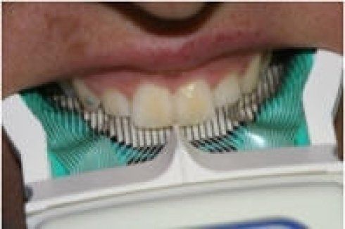 Apparecchio bite hnatologico occlusale