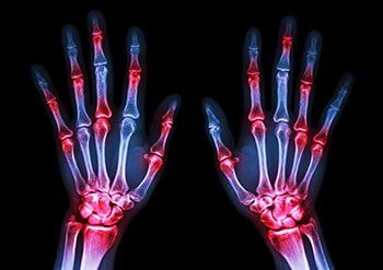 Arthritis at Multiple Joint of Hands — Arthritis Treatment in White Plains, New York