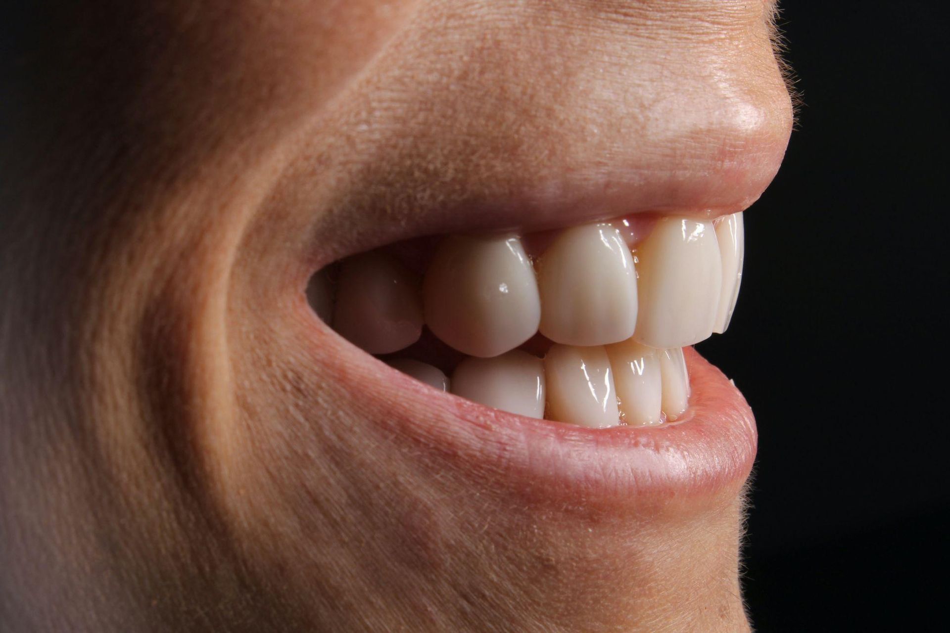 close-up of a person’s smile with new veneers