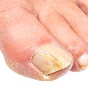 Enhanced foot care treatment