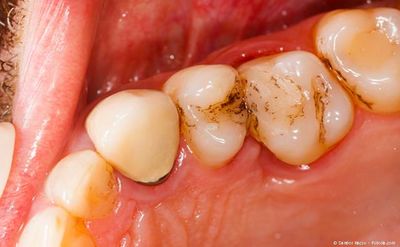 Hochwertige Zahnfüllungen - Zahnarztpraxis Hirschau, Dr. Joana Schönberger