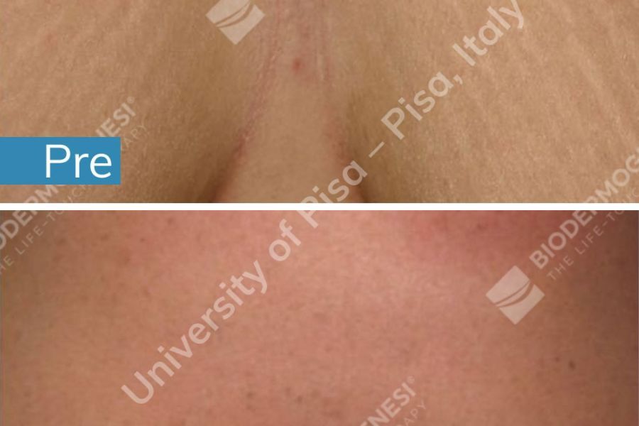 Trattamento biodermogenesi per le smagliature