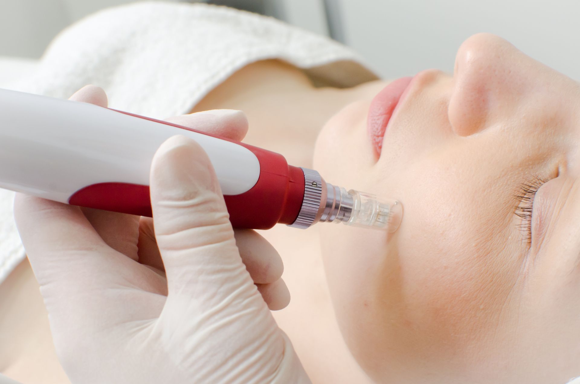 Una donna si sta sottoponendo a un trattamento con microaghi sul viso.