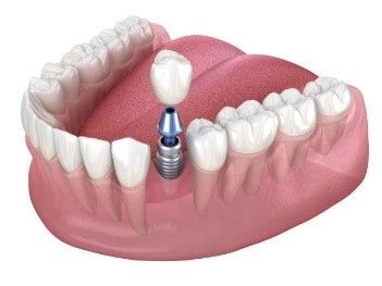 A computer generated image of a dental implant in a person's mouth.